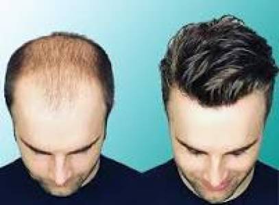 Hair Bonding