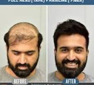 Hair Patch For Men