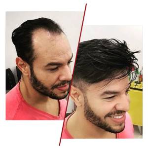 Hair Patches