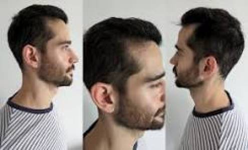 Hair Replacement