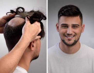 Hair Replacement