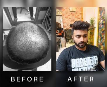 Hair Patch For Men