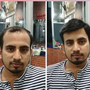 Hair patch Fixing