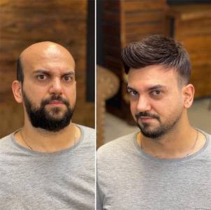 Hair Tapping