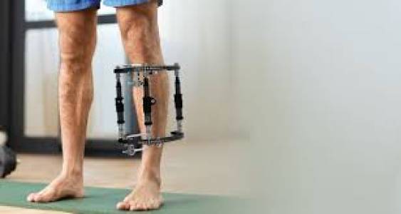 External Fixators