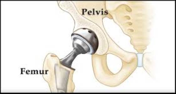 Hip Implants