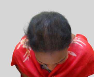 GFC Treatment