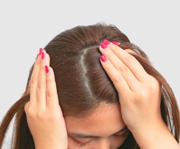 Advanced Dandruff Treatment