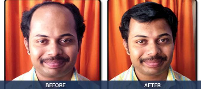 Gents Hair Fixing (Natural & Synthetic)