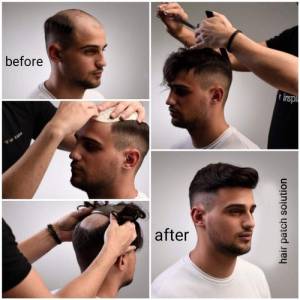 Hair Patch Service in Bhubaneswar
