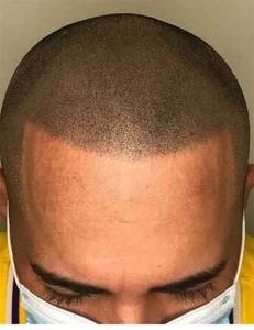 Scalp Micro Pigmentation
