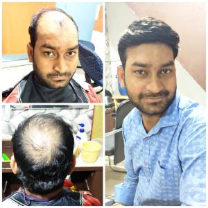 Complete Hair patch Solution in Jaipur