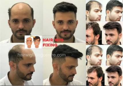 Hair Patch for Men