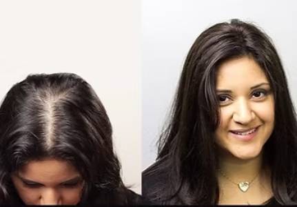 LADIES HAIR PATCHES