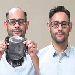 Hair Replacement