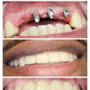 Dental Implants