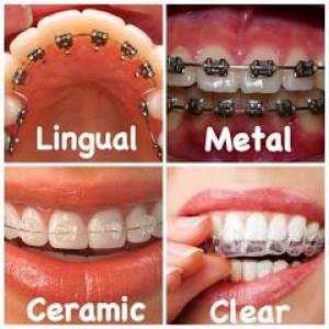 Orthodontic Treatment