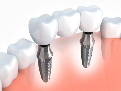 Dental Implants