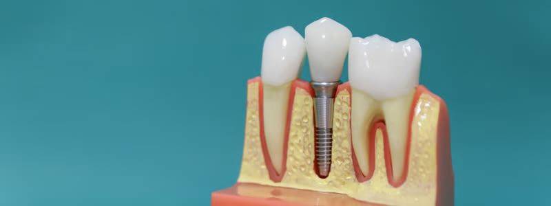 DENTAL IMPLANTS