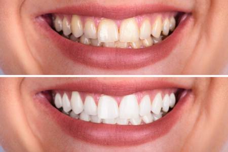 Teeth Whitening/Bleaching