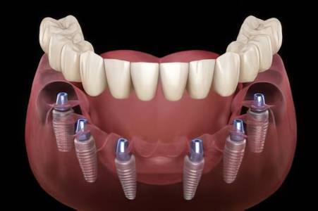 Dental Implants