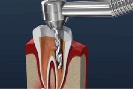 Root Canal Treatment (RCT)