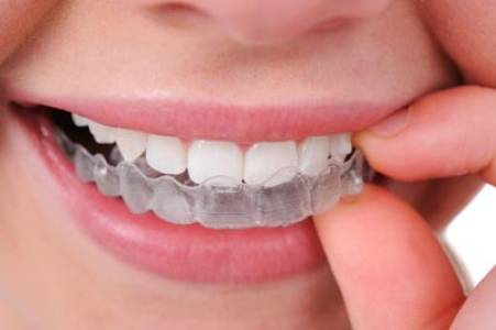 Clear Aligners / Invisible Braces