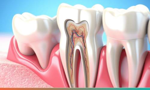 Root canal treatment