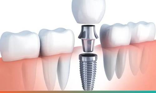 Dental implants