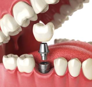 Dental Implants