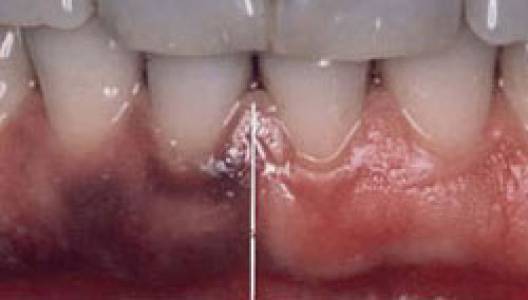 GUM DEPIGMENTATION