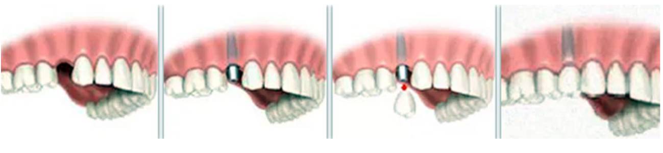Single Tooth Replacement