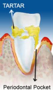 SCALING ROOT PLANING