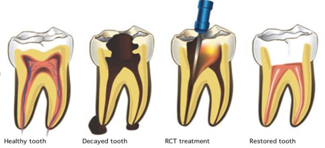 ROOT CANAL TREATMENT