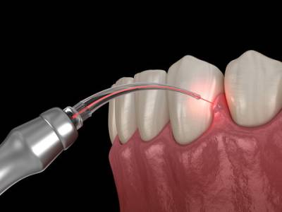 LASER DENTISTRY