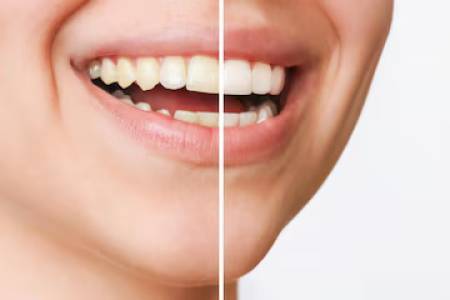 SCALING & TOOTH WHITENING