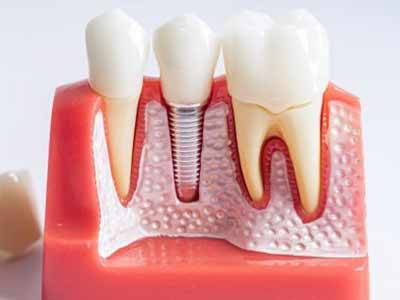 Root Canal Treatment