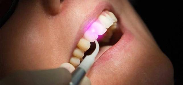 Laser Root Canal Treatment