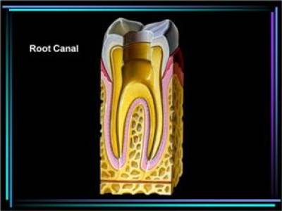 PAINLESS ROOT CANALS