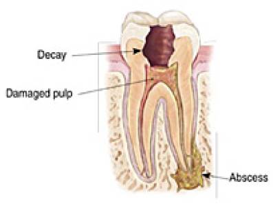 Endodontic Treatment/ Root canal