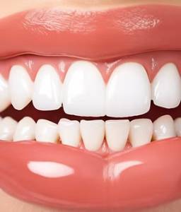 Dental Veneers
