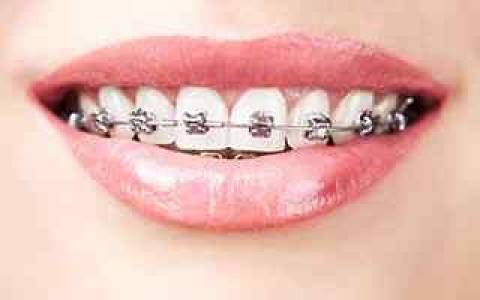 ALIGNERS