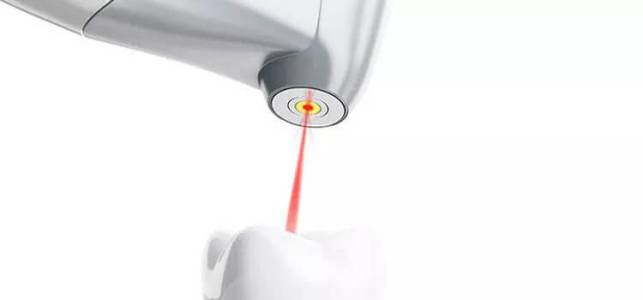 Laser Root Canal