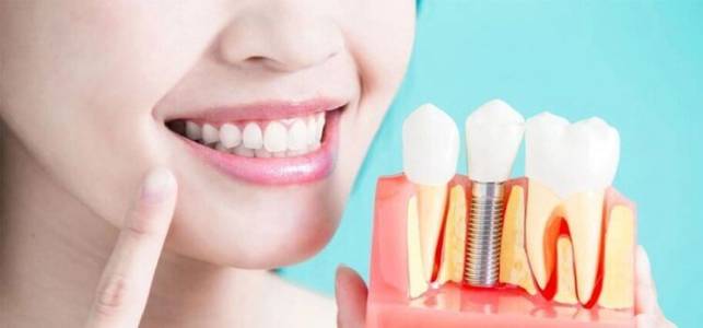 Dental Implants