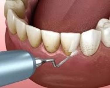 TEETH CLEANING/ SCALING