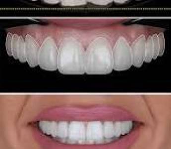 Teeth Whitening