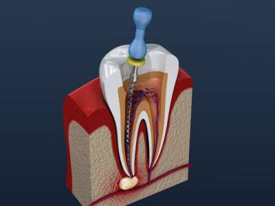 ,Root Canal Treatment