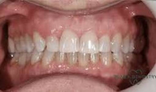 Complete Denture