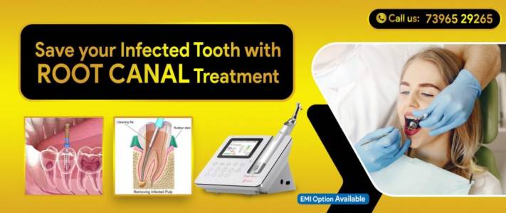 Root Canal Treatment