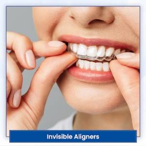 Aligners